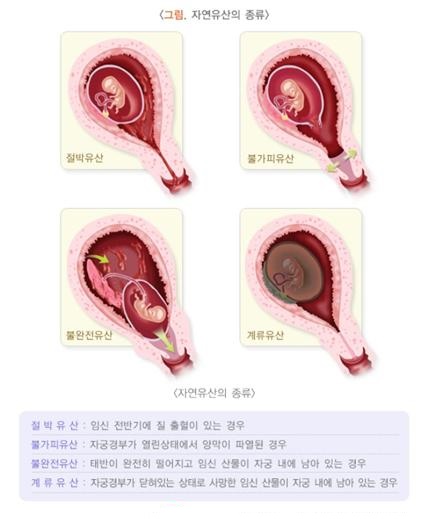 <그림. 자연유산의 종류> 절박유산, 불가피유산, 불완전유산, 계류유산 / 절박유산:임신 전반기 질 출혈이 있는 경우, 불가피유산:자궁경부가 열린상태에서 양막이 파열된 경우, 불완전유산:태반이 완전히 떨어지고 임신 산물이 자궁 내에 남아 있는 경우, 계류유산:자궁경부가 닫혀있는 상태로 사망한 임신 산물이 자궁 내에 남아 있는 경우